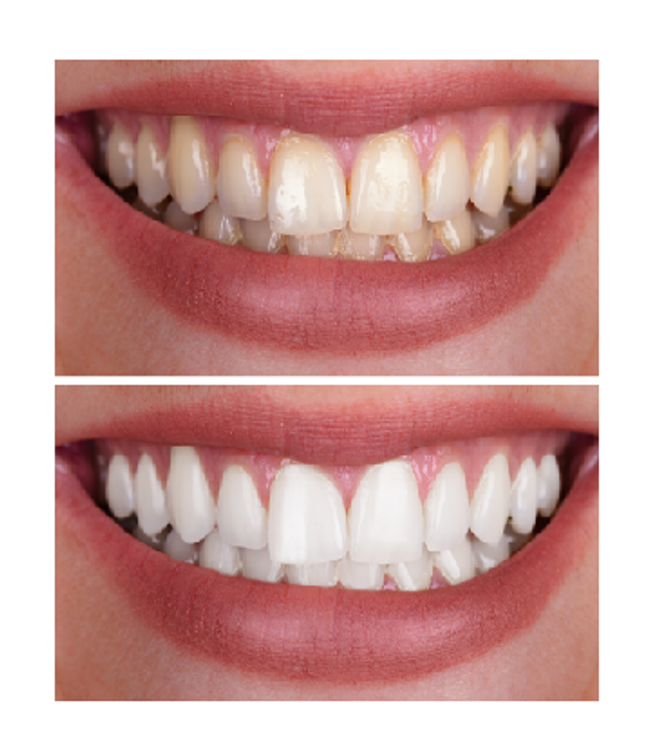 360 teeth whitening: before and after results