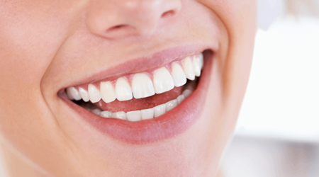 How Long Does Teeth Whitening Last?
