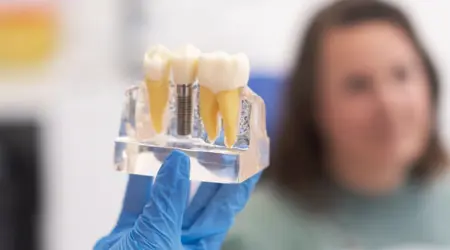 How Long Do Dental Implants Take To Heal?