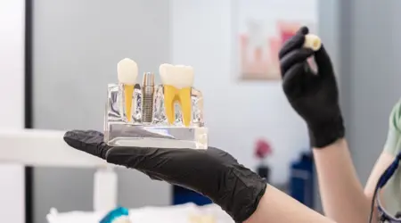 How long do dental implants last?