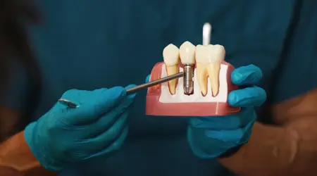 Should I Get Dental Implants: Are They Worth It?